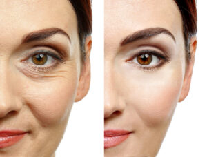 A close up of a woman’s face before and after a treatment.
